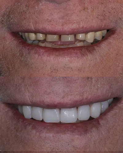 Reabilitação da arcada superior com lentes, antes e depois do tratamento