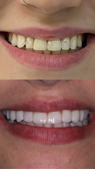 Arcada superior reabilitada com lentes, antes e depois do tratamento