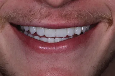 Vista aproximada de um sorriso com lentes, mostrando o acabamento e a translucidez dos dentes