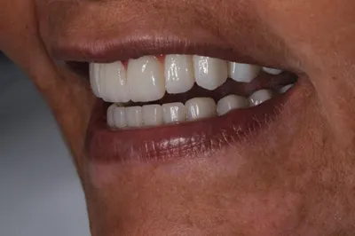 Prótese fixa sobre implantes instalada na arcada superior, vista de perfil com os dentes em oclusão